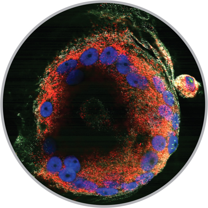 Spurred by HIV infection, immune cells have fused into a single, giant cell in this image from microbiologist Michael Bukrinksy's lab.
